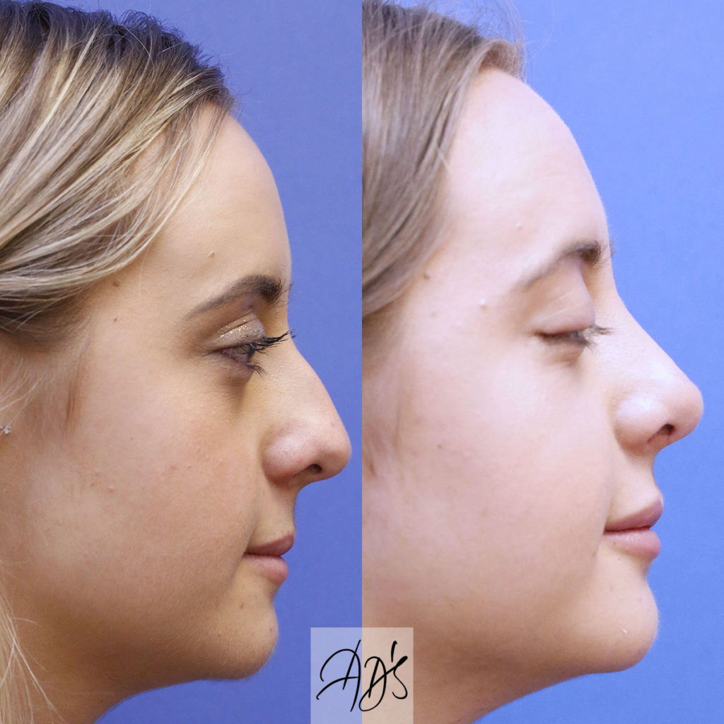 London Facial Surgery Nose & Nasal Tip Surgery (Rhinoplasty)